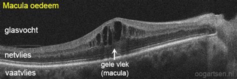 Macula oedeem: vocht onder de gele vlek .